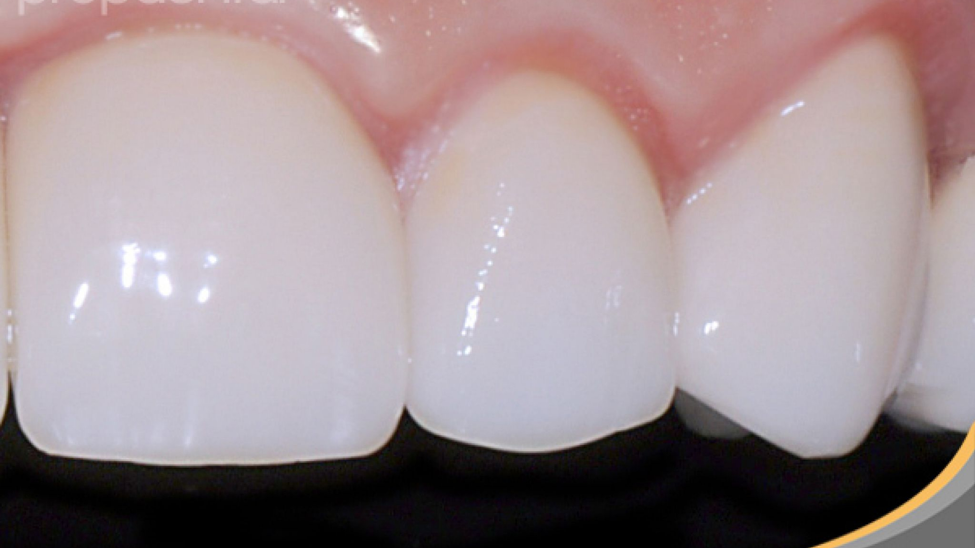 Porcelanas dentales
