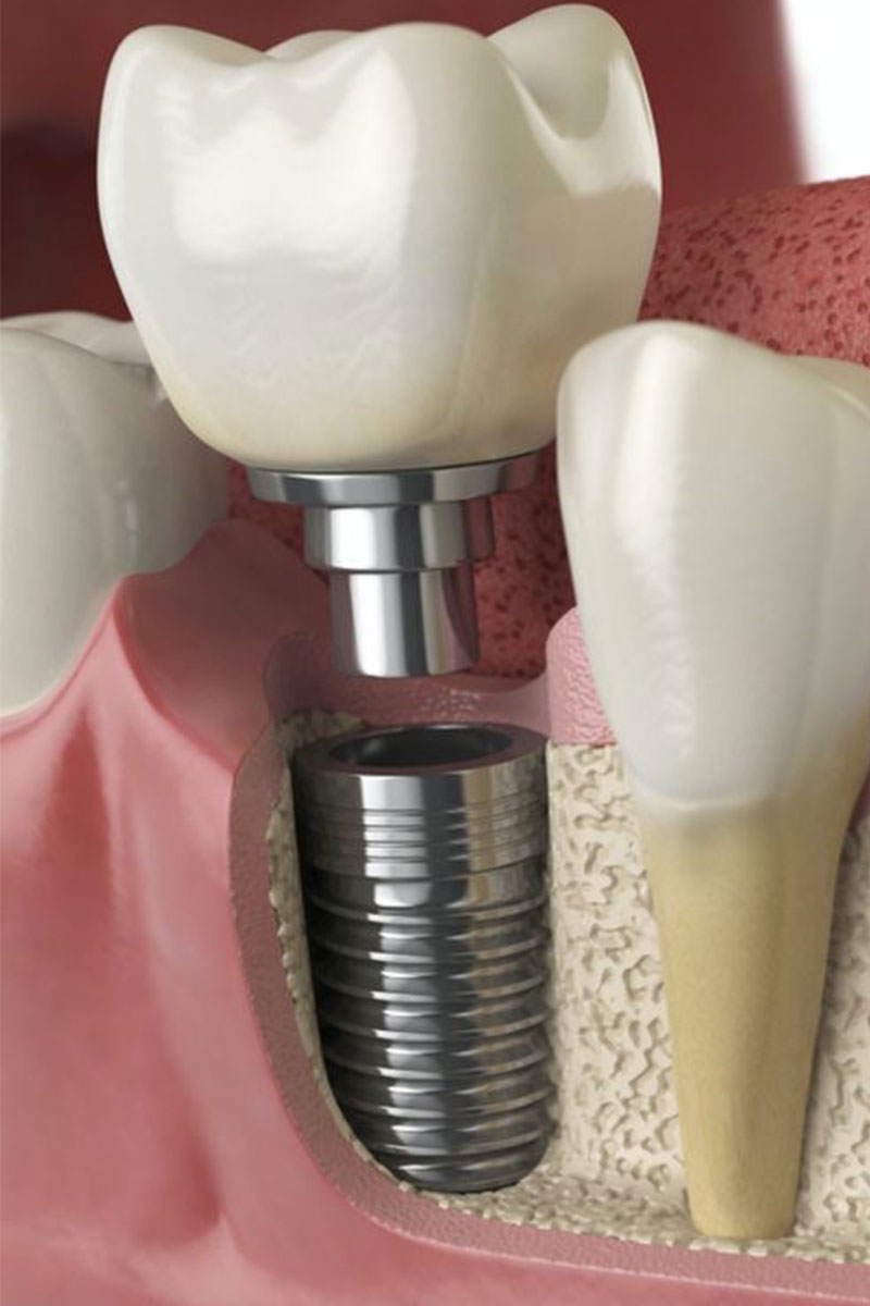 Implantes dentales en Ortodental