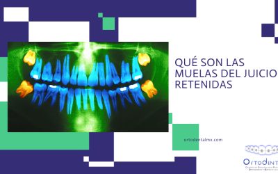 ¿Qué son las muelas del juicio retenidas?