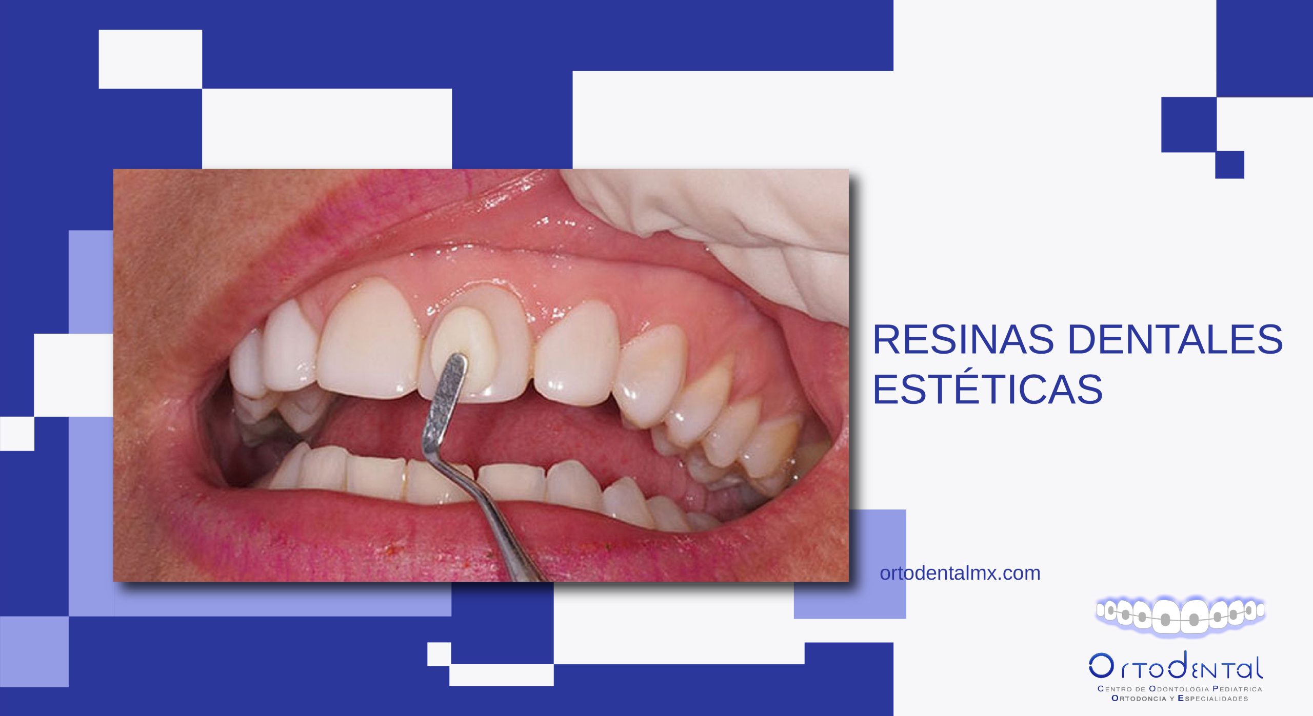 Resinas Dentales Estéticas - Ortodental