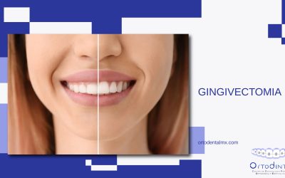 Gingivectomía