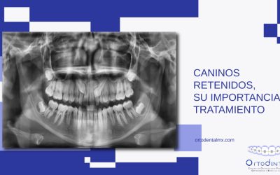 Caninos retenidos, su importancia y tratamiento