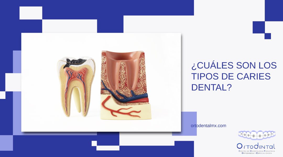 ¿Cuáles son los tipos de caries dental?