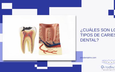 ¿Cuáles son los tipos de caries dental?