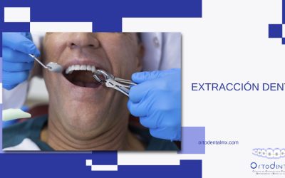 Extracción dental