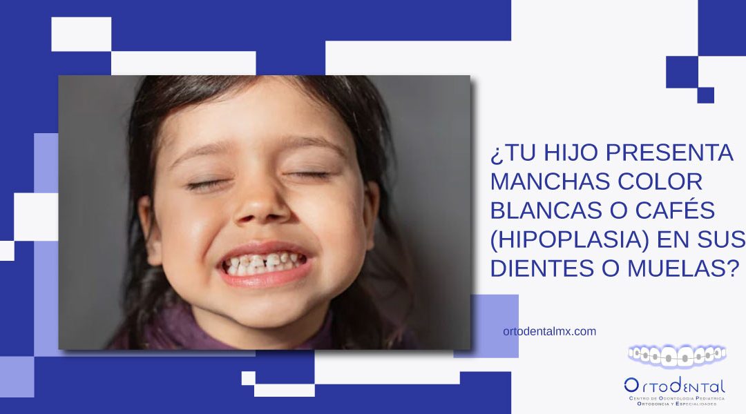 ¿Tu hijo presenta manchas color blancas o cafés (hipoplasia) en sus dientes o muelas?