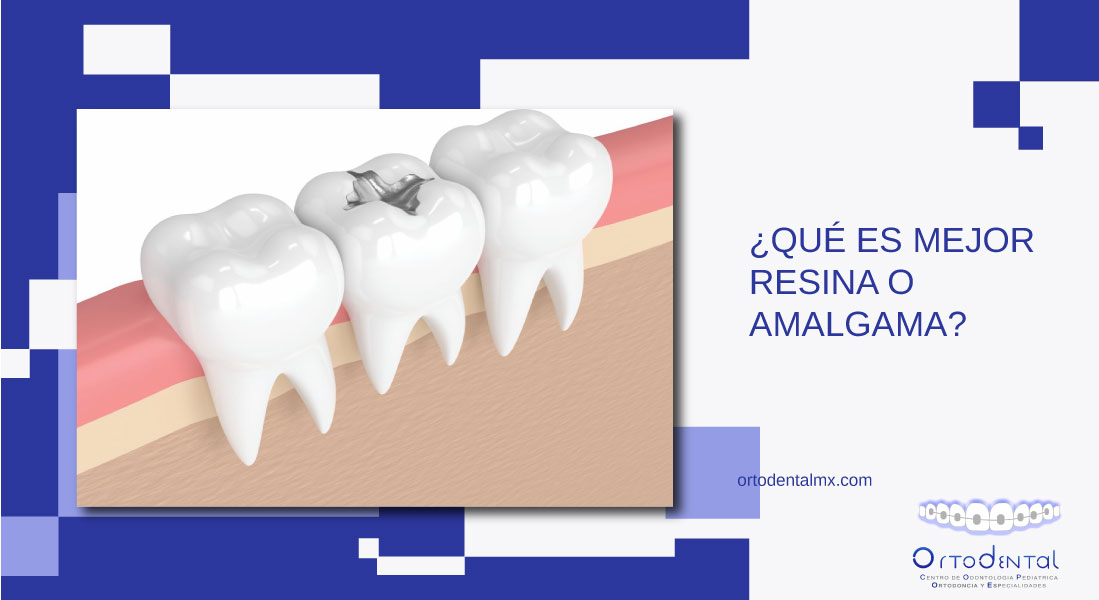 Qué es mejor resina o amalgama Ortodental