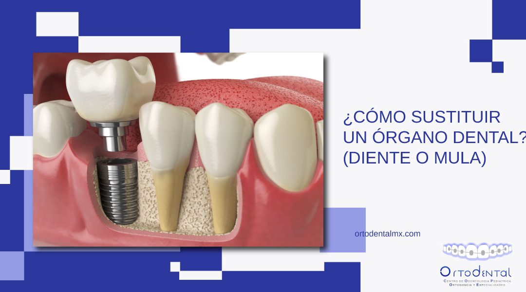 ¿Cómo sustituir un órgano dental? (diente o muela)